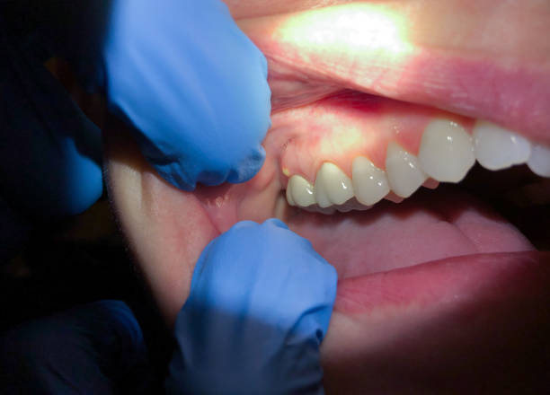 Best Emergency Dentist for Lost Fillings or Crowns in Houston, PA